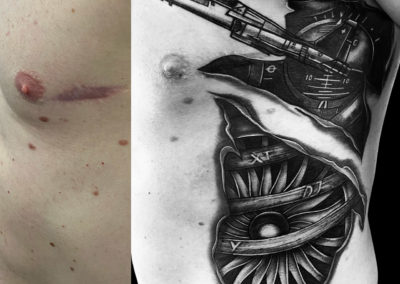 RECOUVREMENT CICATRICE