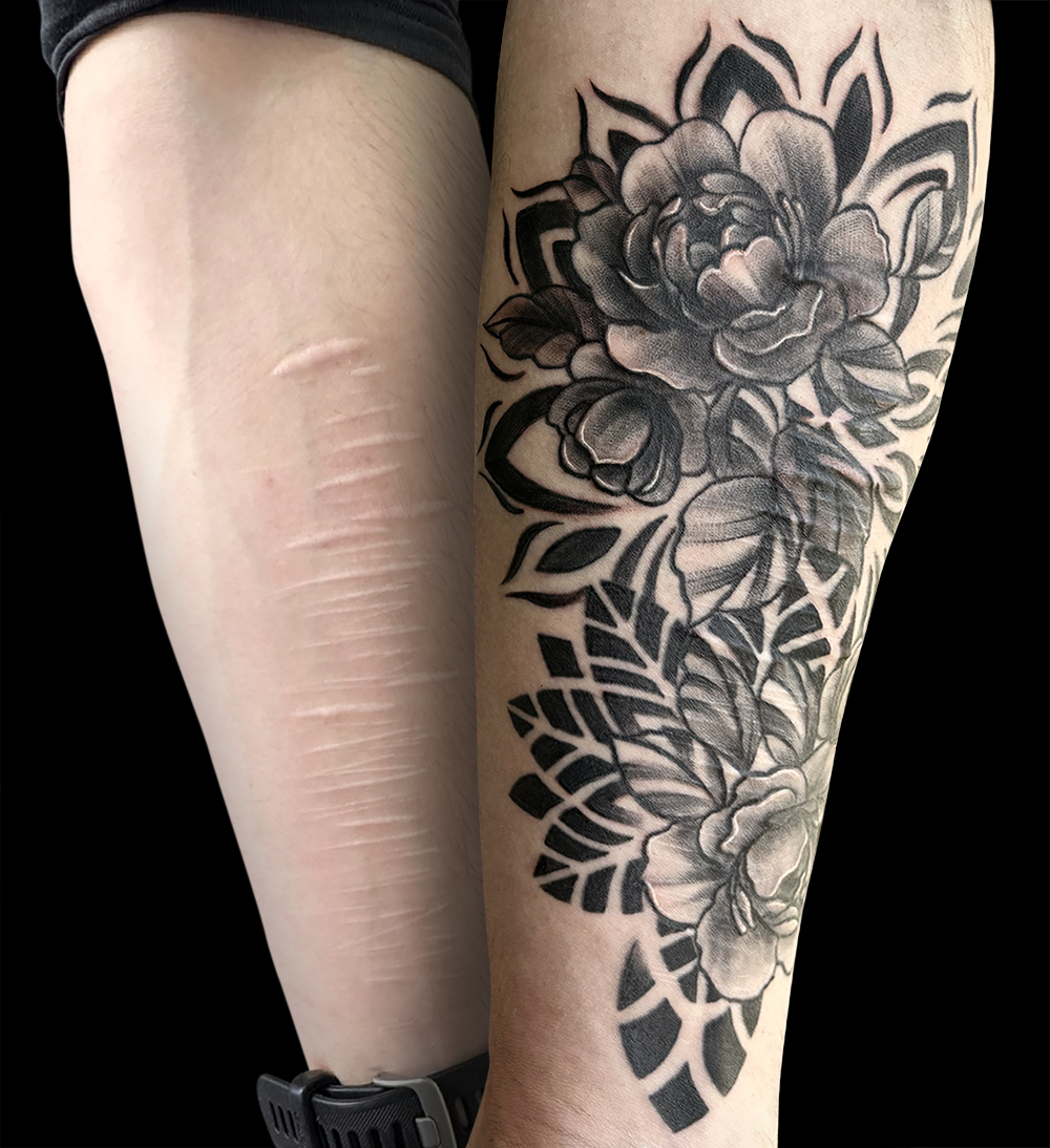 Recouvrement de cicatrices. Tatouages sur cicatrices